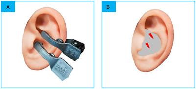 Transcutaneous auricular vagus nerve immediate stimulation treatment for treatment-resistant depression: A functional magnetic resonance imaging study